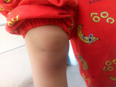Bagaimana-Cara-Menghilangkan-Bekas-Luka-pada-Anak? bekas luka hilang setelah menggunakan laderma